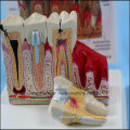 Dental Care Pathological Tooth Anatomical Model